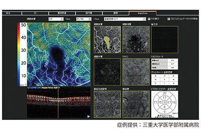 OCT-Angiography_1