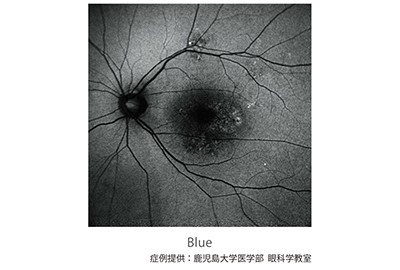 眼底自発蛍光_Blue