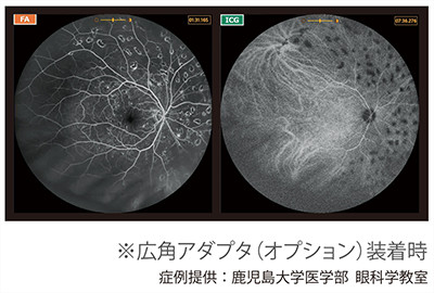 FA_ICＧ同時蛍光眼底造影検査